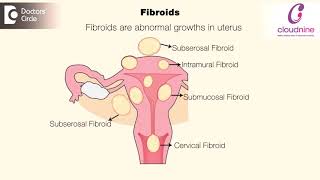 What does big uterus mean  DrSmitha Sha of Cloudnine Hospitals  Doctors Circle [upl. by Dennis]