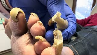 Unbelievable Toenails so long and painful that patient cannot walk [upl. by Renmus]