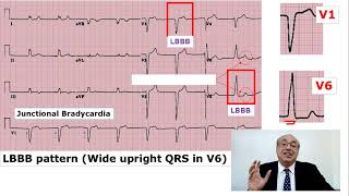 EKG Trainer Case 9 Answer [upl. by Cullin]