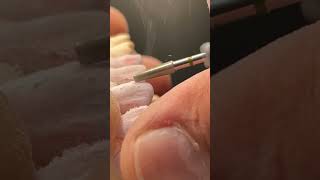 finishing on incisal viralvideo satisfying dental dentalclinic dentist dentistry shortsvideo [upl. by Fraase]