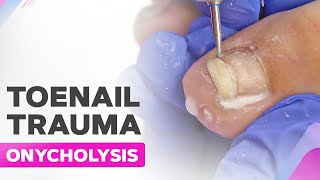 Toenail Trauma  Onycholysis  Cleanup [upl. by Diskin]