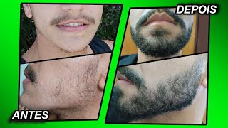 2 ANOS USANDO MINOXIDIL Kirkland e foligain [upl. by Laetitia]