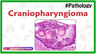 Craniopharyngioma Causes Pathology Clinical manifestations Diagnosis and Treatment [upl. by Cart948]