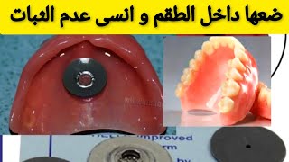 الحل النهائي و الاقتصادي لتثبيت طقم الأسنان المتحرك في الفم بقوة Prothèse dentaire amovible [upl. by Janean]