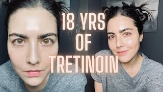 Not Seeing Results with RetinA TRETINOIN Watch This Before You Quit amp Avoid My Biggest Mistake [upl. by Enrico]