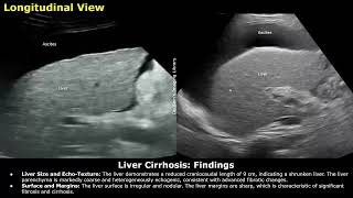 Liver Cirrhosis With Portal Hypertension Ascites amp Splenomegaly Ultrasound Report Example  USG [upl. by Meridith]