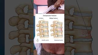 Spinal deformity kyphosis patient shortvideo medicalknowledgeonline [upl. by Klos]