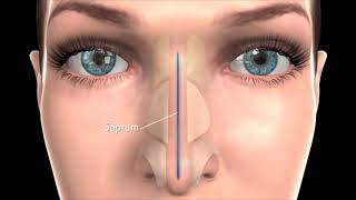 chirurgie cloison sinus en ORL [upl. by Lynnelle]