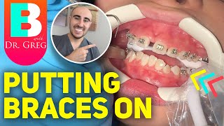 Getting Braces Put On and COLORS Vlog of Time Lapse [upl. by Pollie566]