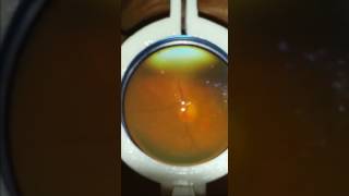 Scanning retina fundus exam by SOT® fundoscopy smartphones 3d print adapter for fundus photography [upl. by Anthia]