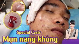 Extract some Special Cysts at hien van spa  Điều trị mụn nang hiệu quả TPHCM  Trọng Hữu  583 [upl. by Eunice]