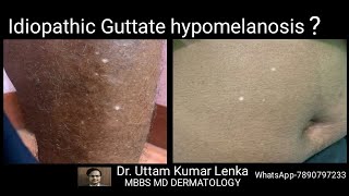 White spots on skin in old age idiopathic guttate hypomelanosis Treatment and prevention [upl. by Sinaj]