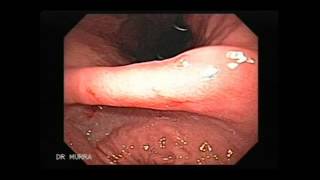 Video clip of an Upper Endoscopy [upl. by Reeva]