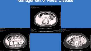 Outcomes for patients with locally advanced renal cell carcinoma Christopher G Wood MD UT [upl. by Halik]