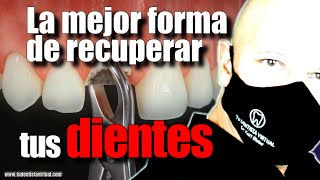 LOS IMPLANTES DENTALES CAMBIARON ¿LO SABÍAS [upl. by Uolymme]