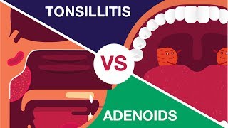 What is Adenoids and Tonsillitis Complete Video [upl. by Dorinda616]