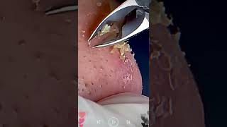 Skincare  Blackheads Removal 169 skincare skincare blackheads blackheads [upl. by Mochun]