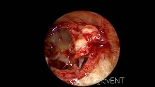 Endoscopic tympanosclerosis and atresia EAC surgery [upl. by Keligot]