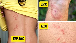 What Bit Me How To Identify The Most Common Bug Bites [upl. by Eirod]