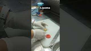 lipoma lipomatreatment [upl. by Spears]