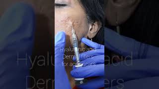 Hyaluronic filler injections for acne scars [upl. by Reichel]