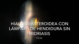 Hialosis asteroidea con lámpara de hendidura sin midriasis [upl. by Howell]