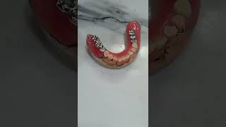 Dental prosthesis with metal teeth dental [upl. by Goddart]