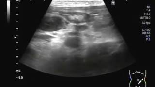 Ultrasound Video showing Mesenteric lymphadenitisLymphadenopathy or adenopathy [upl. by Everest]