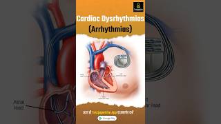 Cardiac Dysrhythmias Arrhythmia Part1  Types of Cardiac Arrhythmia Cardiac Dysrhythmias [upl. by Chick773]