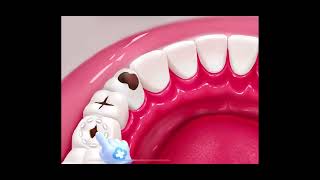 Ultimate Guide to Teeth Cavity Treatment  BeautyByte Animations [upl. by Rozelle]