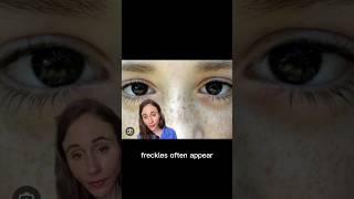 Freckles vs Age Spots dermatologist DrDrayzday [upl. by Reffotsirhc]