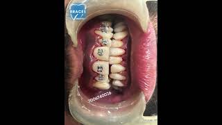 Class 2 div 1 Malocclusion  BRACES trending dentist toothdental dentalcare dentalclinic tooth [upl. by Mello826]