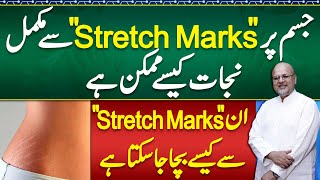 Stretch Mark Removal  Stretch Marks During Pregnancy  Cream For Stretch Marks and Laser Treatment [upl. by Maloy]