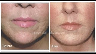 Juvederm Filler For Acne Scars [upl. by Anayek531]