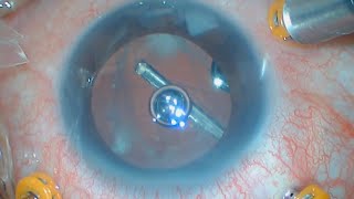 Vitrectomy to Remove Retained Lens Fragments  Posterior Capsular Rupture  Cataract Surgery [upl. by Bremble804]