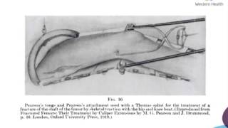 Traction in Orthopaedics by Dr Navid Nazarian [upl. by Song]