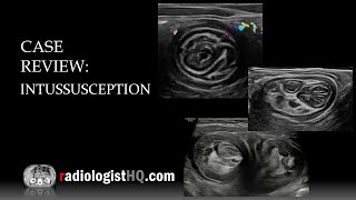 Ultrasound of Intussusception [upl. by Wayne]