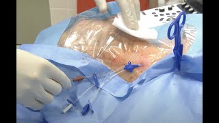 Central venous catheter insertion Internal jugular vein [upl. by Undis]