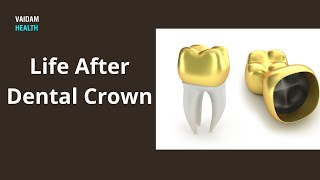 Life After Dental Crown [upl. by Finlay]