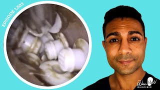 1503  TOP 10 MOST BIZARRE FOREIGN BODY EAR EXTRACTIONS 🫣 [upl. by Irmgard205]