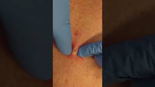 Sebaceous cyst extraction by a dermatologist shorts pimplepopping  CONTOUR DERMATOLOGY [upl. by Haibot501]