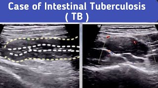 Ultrasound Intestinal Tuberculosis TB [upl. by Enomahs]