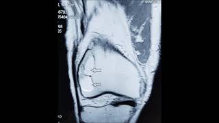 Right chondromyxoid fibroma femur [upl. by Ilah]