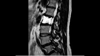 rare case of hemangioma L2 L3 [upl. by Nitsrik426]