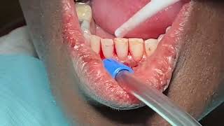 ApicoectomyEndodontic Secondary InfectionHow To Approach [upl. by Acceber]