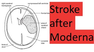 Stroke and death after Moderna [upl. by Nnaylime]