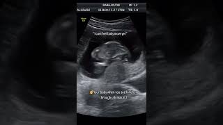 Baby movement in womb pregnancy ultrasound pregnancycare [upl. by Reidar389]