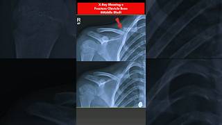 Clavicle Bone Fracture⚡️ Shoulder Xray xray radiology bones radiography radiographerusn [upl. by Kling]