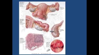 GYNECOLOGIE Tuberculose génitale [upl. by Aleinad681]