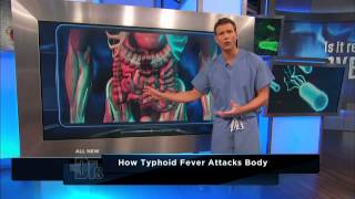 How Typhoid Fever Affects the Body  The Doctors [upl. by Valene]